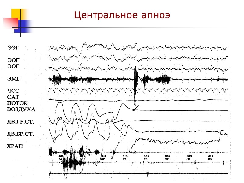 Центральное апноэ